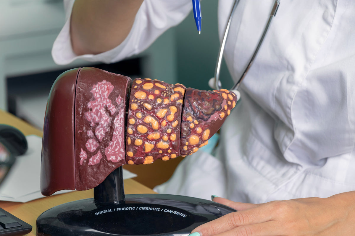 La cirrosis es la pérdida de tejido hepático en el hígado, como consecuencia del progreso de la fibrosis hepática y de la acumulación de tejido fibrótico.