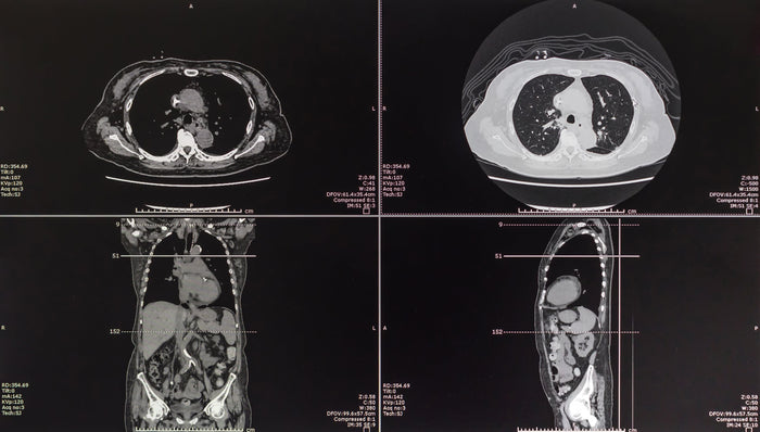 Exploración del cáncer mediante tomografía computarizada (TC)