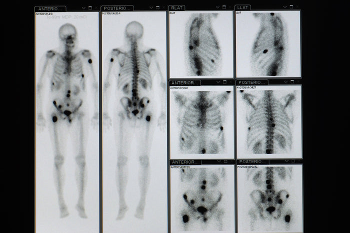 Metástasis observadas mediante exploraciones con rayos X