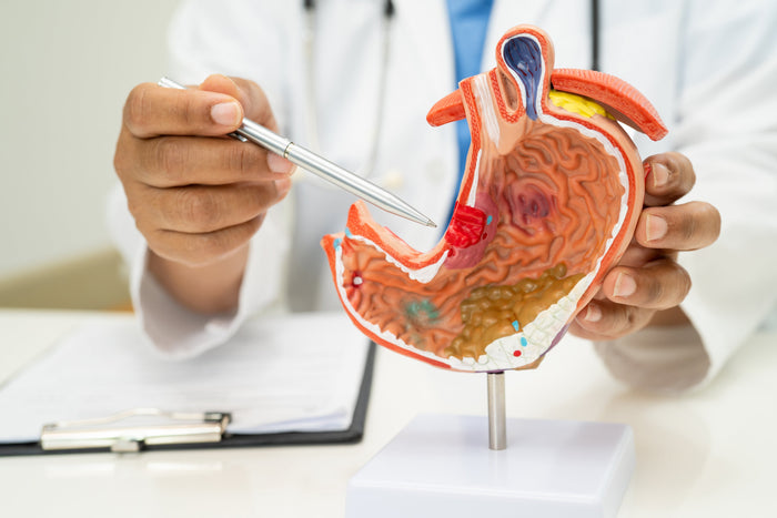 El cáncer de estómago es un tipo de cáncer gastrointestinal que afecta a dicho órgano