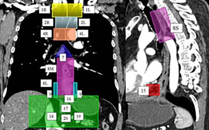 La tomografía computarizada (TC) es un método de escaneo muy utilizado para la detección del cáncer de esófago